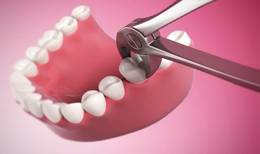 Trường hợp nào nên nhổ răng? Nhổ răng đau mấy ngày?