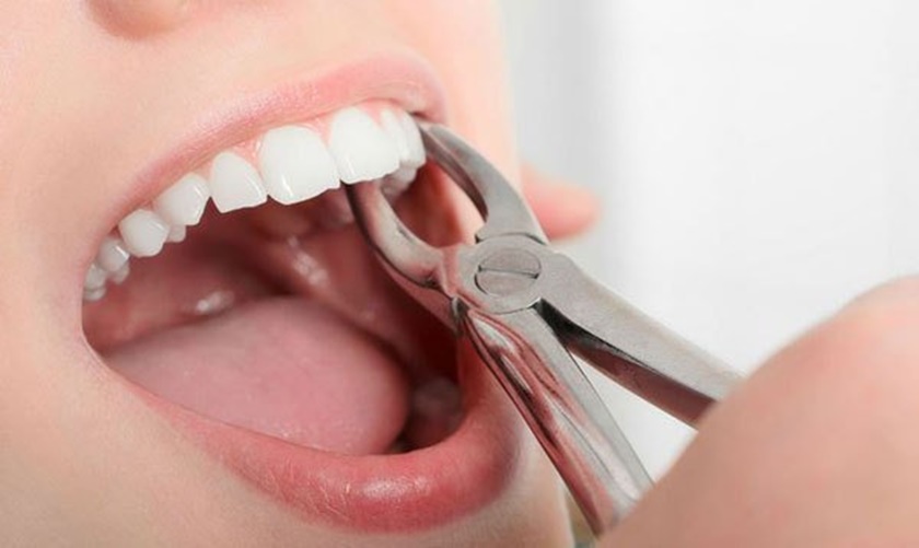 Cảm giác đau sau khi nhổ răng sẽ kéo dài từ một đến ba ngày tùy thuộc vào cơ địa của mỗi đối tượng bệnh nhân răng miệng