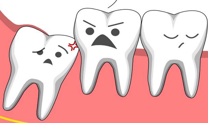 Răng khôn hàm dưới thường có xu hướng mọc lệch